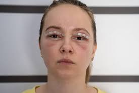 swelling after plastic surgery common