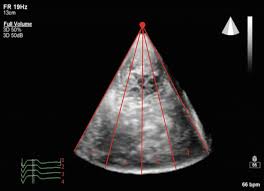 3d echocardiography in critical care