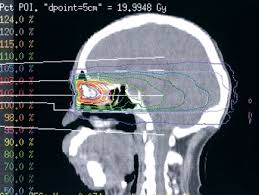 adnexal complications of radiotherapy