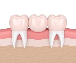 dental bridge vs tooth implant which