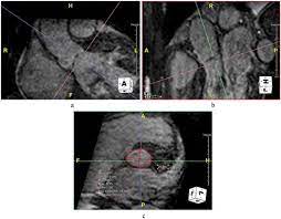 Cardiac Magnetic Resonance Imaging