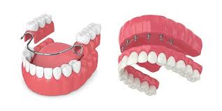 dental bridge vs implants crown