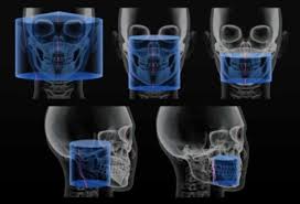 dental cone beam ct scan omega pds
