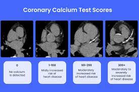 coronary calcium test what is it