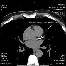 what does a cardiac calcium score show