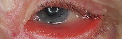 eyelid disorders springerlink