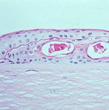 Corneal Dystrophies Orphanet Journal