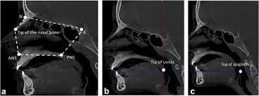 cone beam ct evaluation of skeletal and