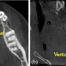 cone beam ct images showing a maxillary