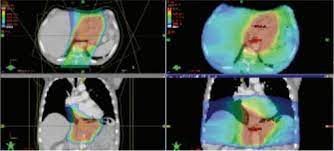 proton therapy for esophageal cancer