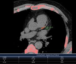calcium scoring