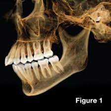 dental cone beam cbct scanning