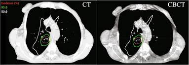 cone beam ct based dose calculation in