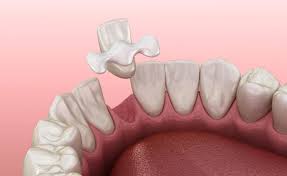 what are maryland dental bridge pros