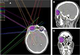 presumed choroidal lymphoma