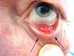 inside eyelid chalazion eyelid cyst