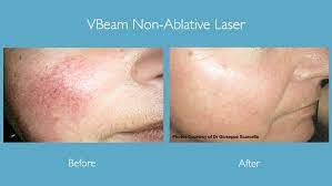 vbeam laser treatment for non ablative