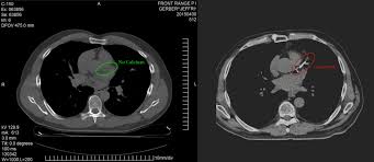 coronary artery calcium score