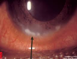 Disease 2 Cornea And Cataracts
