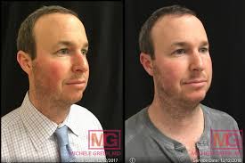 vbeam before after photos dr