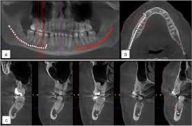 mandibular cs