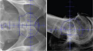 proton therapy for prostate cancer