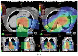 the utility of proton beam therapy with