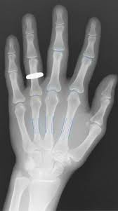 hand radiograph with measurement jsw