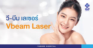 ว บ ม เลเซอร vbeam laser ย นฮ