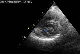 Mitral Valve Area By Planimetry On