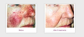 v beam pulsed dye laser lakes dermatology