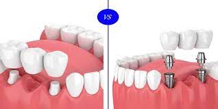 dental implants vs bridges the great