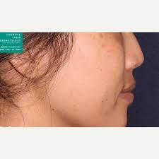 vbeam laser treatment cost recovery