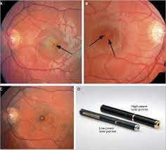 eye doctors warn of retinal injuries