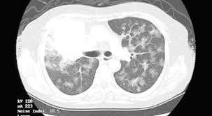 Multiple Lung Metastases Presenting As