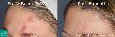 vbeam perfecta laser skin treatment