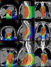 proton therapy with concur