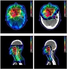 proton therapy a treatment for tumours