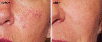 v beam laser grafton dermatology