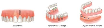 full mouth dental implant costs and options