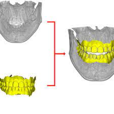 low dose dental cbct uses a small