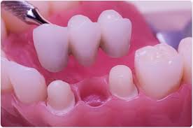 dental bridge vs implant which one is