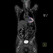 new pet ct scan improves detection in