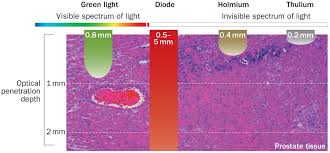 laser treatment of benign prostate