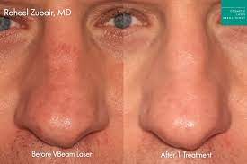 vbeam perfecta laser skin treatment