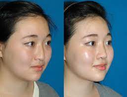 asian nose job surgery