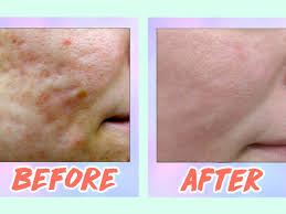 5 acne scar laser treatments in