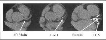 electron beam computed tomographic