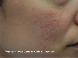 rosacea vbeam laser treatment dermatim