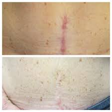 stretchmarks scars in chevy chase md